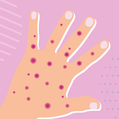 Bệnh truyền nhiễm Real Time PCR Monkeypox Test Kit MPXV CE Đã đăng ký 1 Test/Hộp